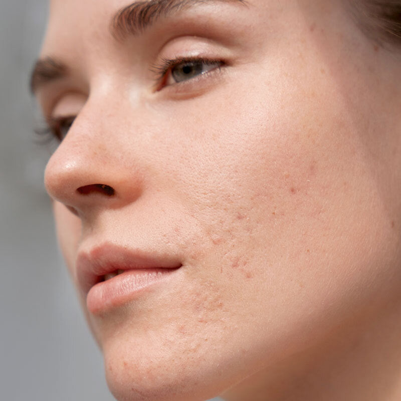 Comment choisir le meilleur tonique pour peau acnéique